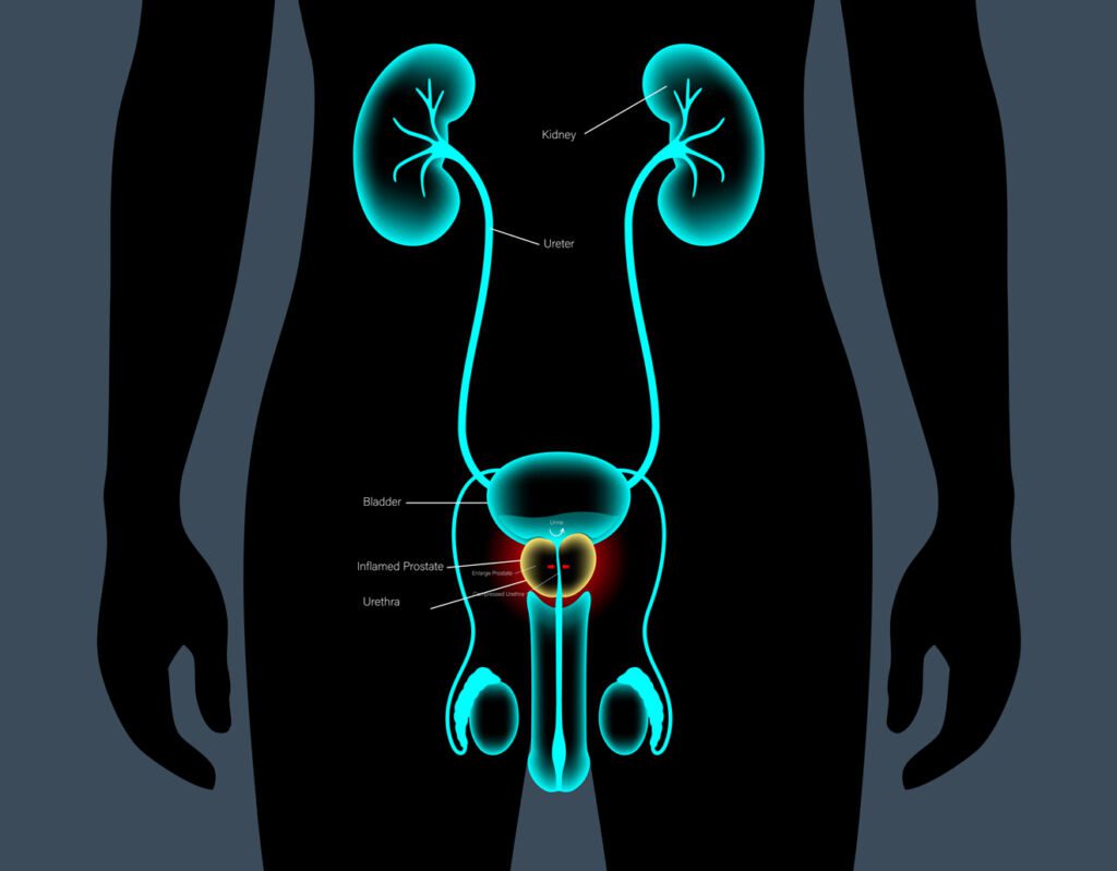 maladies de la prostate