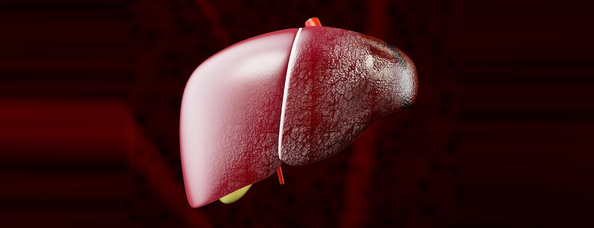 Comprendre la cirrhose du foie : symptômes, causes et traitements