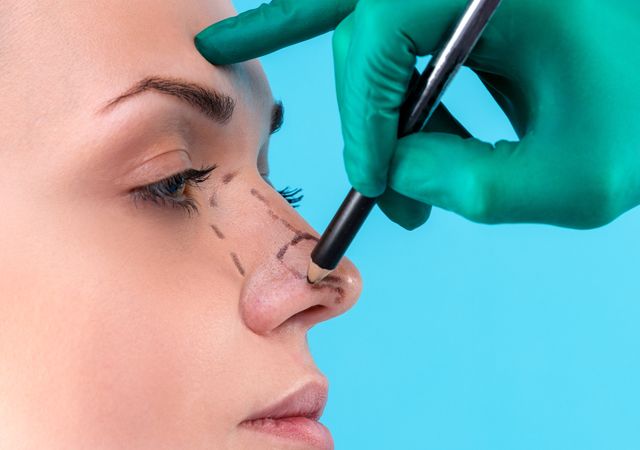 Tout ce que vous devez savoir sur la rhinoplastie : le guide ultime