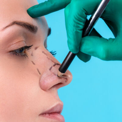 rhinoplastie1