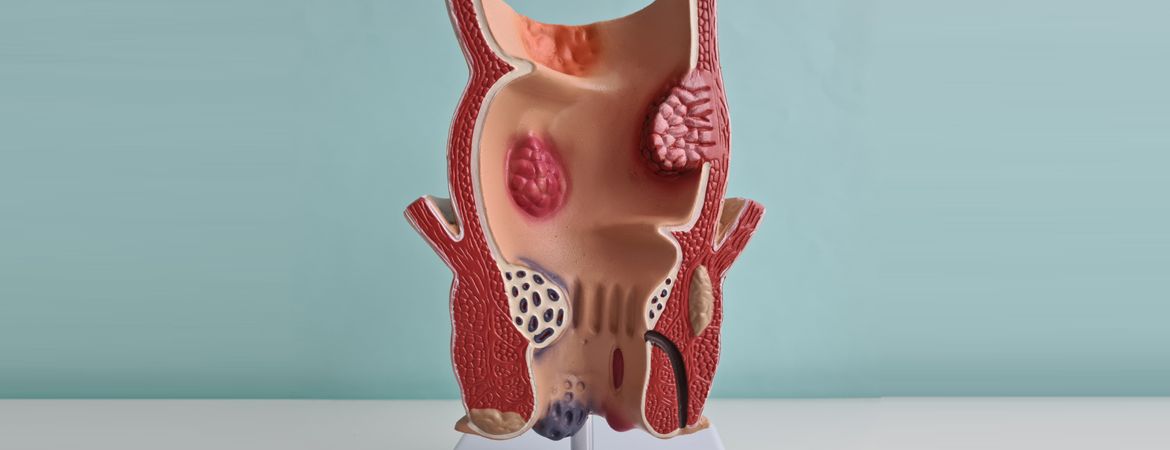 C’est quoi les hémorroïdes ?