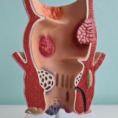 hémorroides1