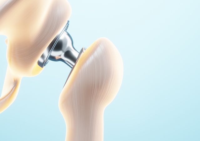 Prothèse de Hanche à la Clinique Méditerranéenne