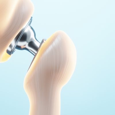 Prothèse de Hanche à la Clinique Méditerranéenne