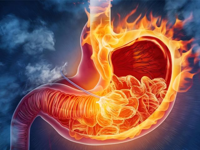 Ulcères et Stress : Mythe ou Réalité ? Découvrez la Vérité Sur Cette Relation Étonnante !
