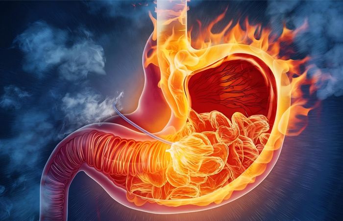 Ulcères et Stress : Mythe ou Réalité ? Découvrez la Vérité Sur Cette Relation Étonnante !