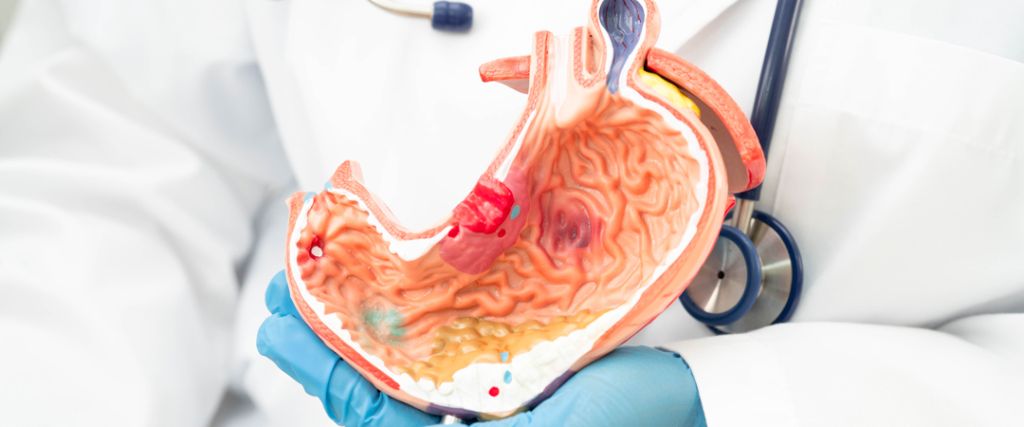 Ulcères et Stress : Mythe ou Réalité ? Découvrez la Vérité Sur Cette Relation Étonnante !