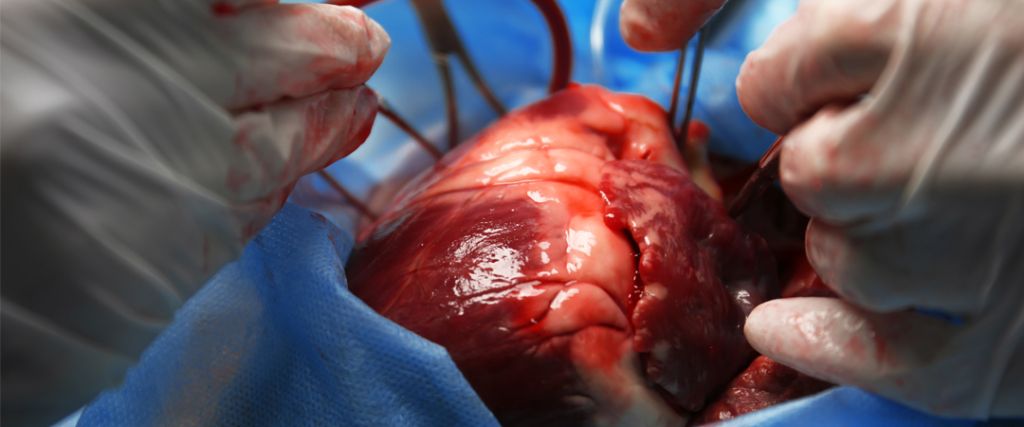 Tout Savoir sur la Chirurgie Valvulaire : Techniques, Risques et Récupération